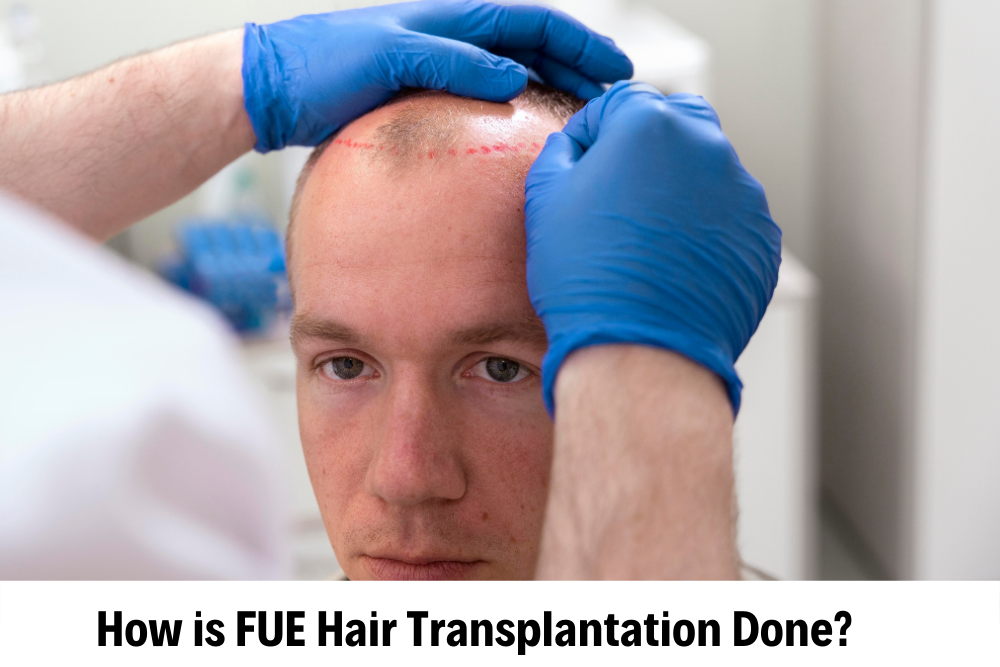 Sapphire Fue Hair Transplantation